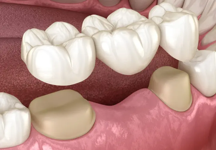 Model protetycznego mostu dentystycznego na zębach.