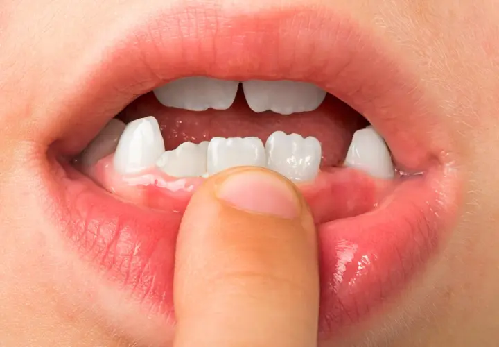 Boca de niño mostrando dientes temporales y un dedo que señala la encía, indicando la etapa en que a que edad se caen los colmillos.