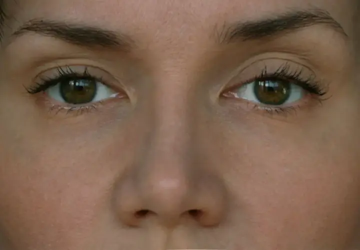 Zbliżenie na oczy kobiety, widoczna lekka ptoza po botoksie.