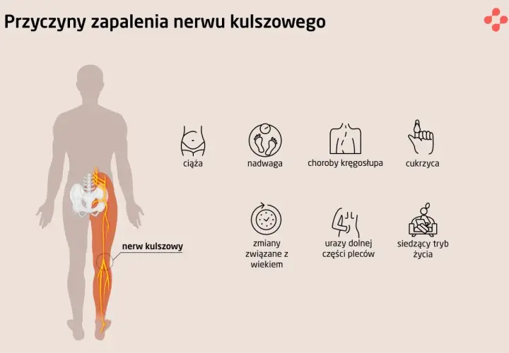 Ilustracja przedstawia przyczyny zapalenia nerwu kulszowego: ciążę, nadwagę, choroby kręgosłupa, cukrzycę, zmiany związane z wiekiem, urazy pleców i siedzący tryb życia.