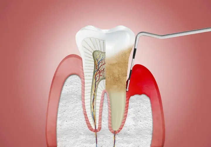 Przekrój zęba z widocznymi naczyniami krwionośnymi i nerwami. Narzędzie dentystyczne usuwa kamień nazębny, odsłaniając zdrowe przyzębie.