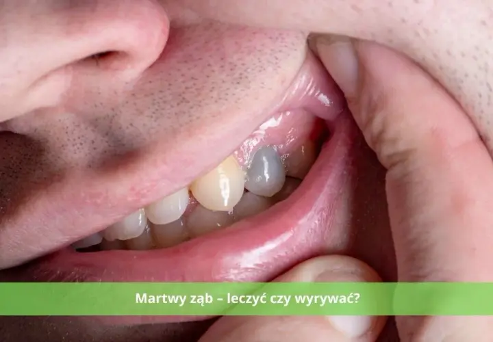 Martwy ząb: leczyć czy usunąć? Co wybrać? Koszty i zdrowie