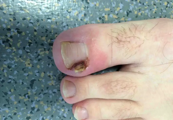 Gros plan d'un ongle incarné au pied, présentant une inflammation et une légère infection.