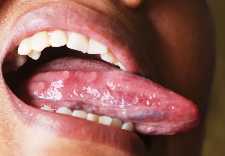 Boca abierta mostrando la lengua con varias llagas blancas y rojas, indicando un problema de llagas en la lengua.