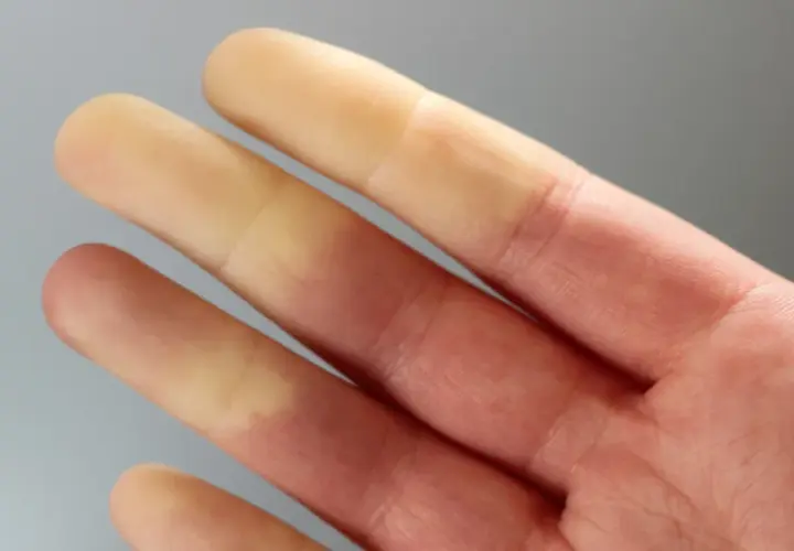 Palce dłoni z widocznym objawem Raynauda – białe, blade końcówki palców przechodzące w zaczerwienienie.
