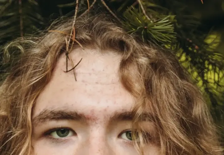 Primer plano de una persona con cabello rubio y ojos verdes, con **acné en la frente** y ramas de pino alrededor.