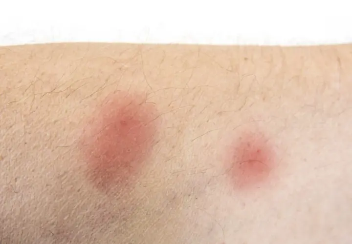 Hausstaubmilben Allergie Symptome: So erkennen Sie die Anzeichen