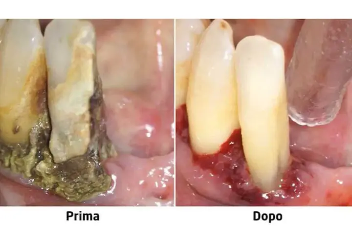 Prima e dopo: gengive infiammate e denti con tartaro, poi gengive sane. La piorrea può portare alla caduta dei denti.