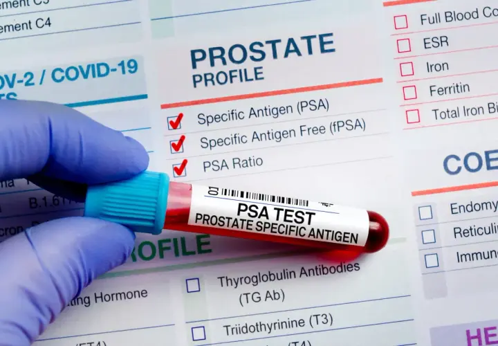Rękawiczka trzyma probówkę z krwią do badania PSA. Wyniki analizy PSA pomogą ocenić, jak obniżyć psa prostaty.