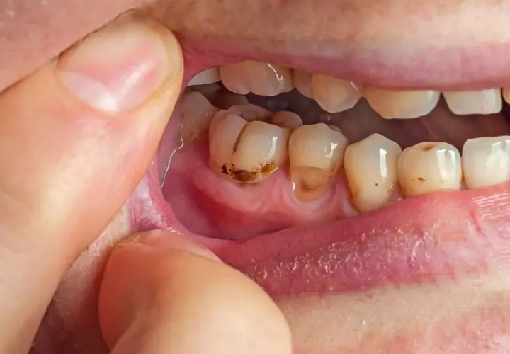Denti cariati e gengive infiammate, possibili cause di alito cattivo dallo stomaco.