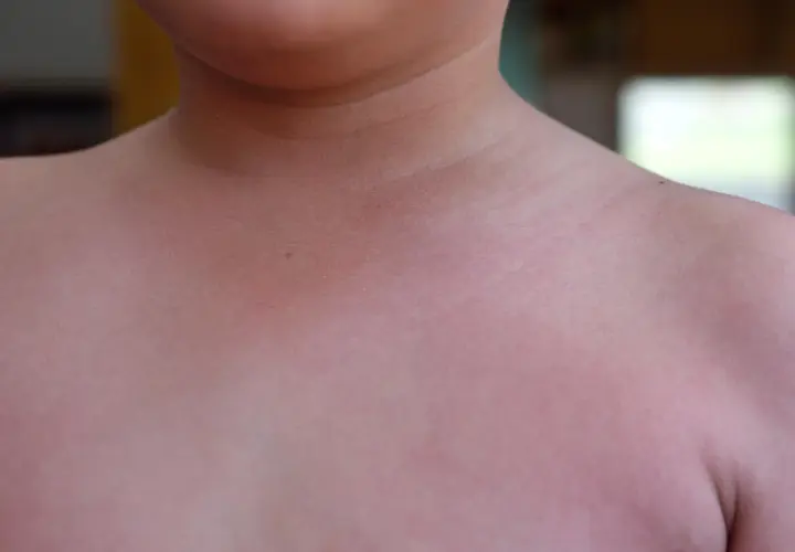 Pelle arrossata con piccoli puntini scarlattina inizio, visibili sul collo e sulle spalle di un bambino.