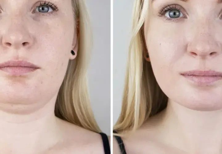 Före- och efterbilder visar resultat av fettfrysning för att minska dubbelhaka.