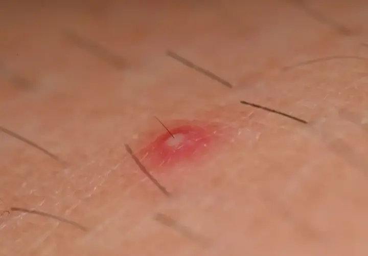 Bolesne krosty pod pachami? Zobacz domowe sposoby na ulgę i pozbycie się nieprzyjemnych zmian.