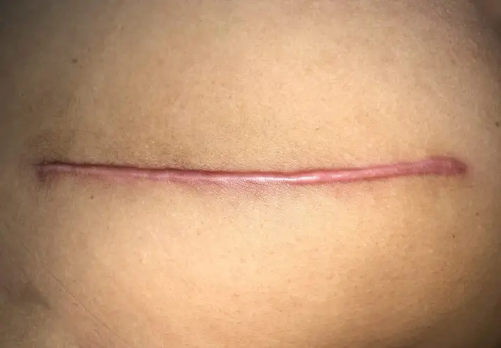 Gros plan d'une cicatrice sur la peau, légèrement rosée et bombée. Elle semble propre, sans signe de cicatrice qui suinte jaune.