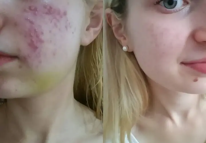Przed i po kuracji Accutane: skóra z trądzikiem i zaczerwienieniami po lewej, gładka i czysta po prawej.