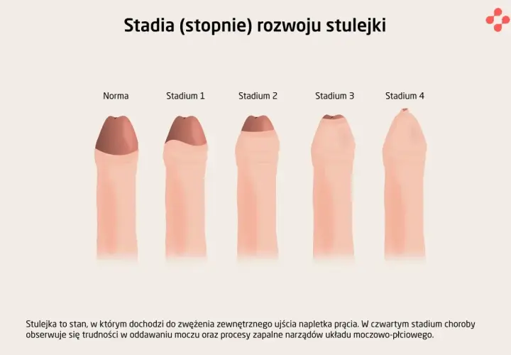 Ilustracja pokazuje stadia rozwoju stulejki u dziecka: od normy do stadium 4, gdzie widoczne są trudności z oddawaniem moczu.