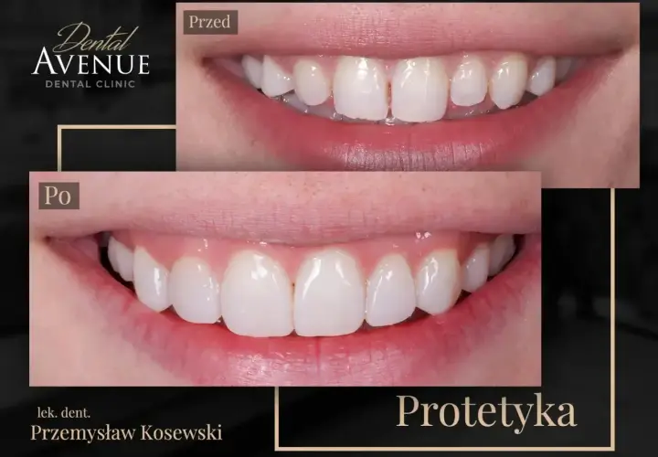 Przed i po: uśmiech z pięknymi, białymi licówkami kompozytowymi. Efekt metamorfozy zębowej.