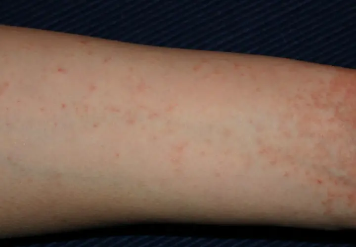 Braccio con eruzione cutanea rossa e pruriginosa, simile a una falsa scabbia.
