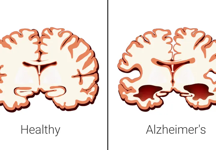 Choroba Alzheimera: neurologiczna czy psychiczna? Rozwiewam wątpliwości