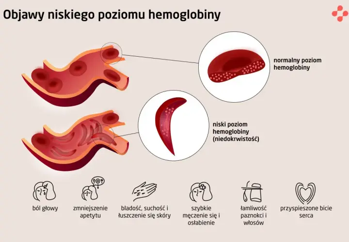 Niski poziom hemoglobiny (niedokrwistość) objawia się bólem głowy, bladością, suchością skóry i szybkim męczeniem.