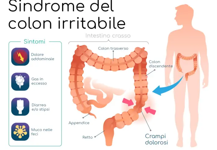 Illustrazione della sindrome del colon irritabile, con sintomi come dolore addominale, gas, diarrea/stipsi e muco. Evidenzia i crampi dolorosi.