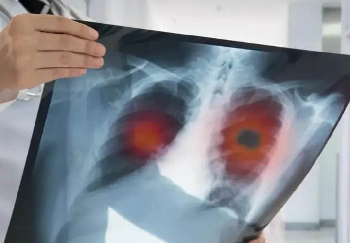Die alarmierenden Symptome des Bronchialkarzinoms erkennen und verstehen