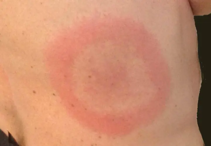 Rött, cirkulärt utslag på huden, liknande en rodnad. Kan vara ett tecken på utslag bebis allergi.