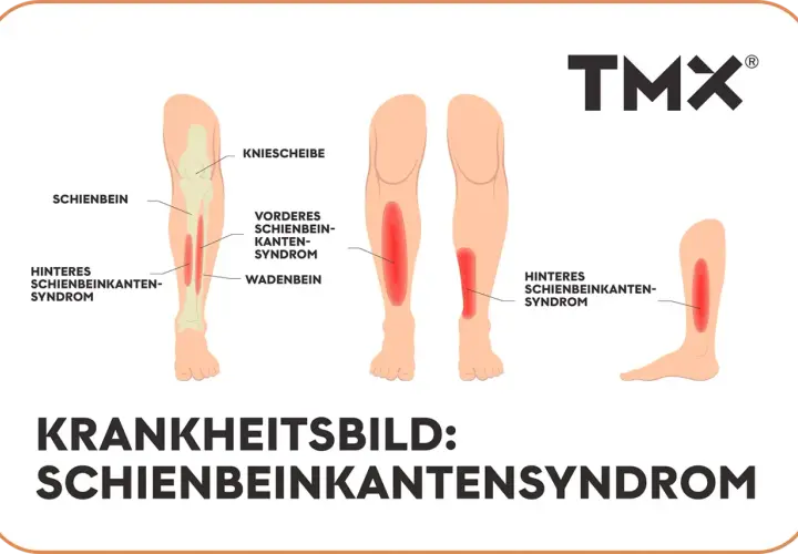 Illustration zeigt das Schienbeinkantensyndrom (shin splint) mit roten Schmerzbereichen am Schienbein und Wadenbein.