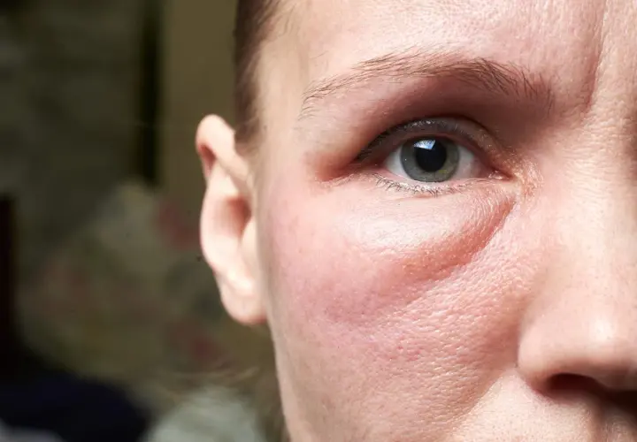 Gros plan sur le visage d'une femme, montrant un œil et une partie de son oreille. La peau sous l'œil est visiblement gonflée, un symptôme courant du visage gonflé pendant les règles.