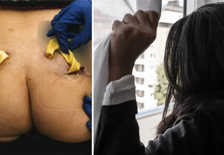 Närbild på en rumpa med synliga ärr och gula kompresser, troligen efter fillers i rumpan. Bredvid en kvinna som tittar ut genom ett fönster.