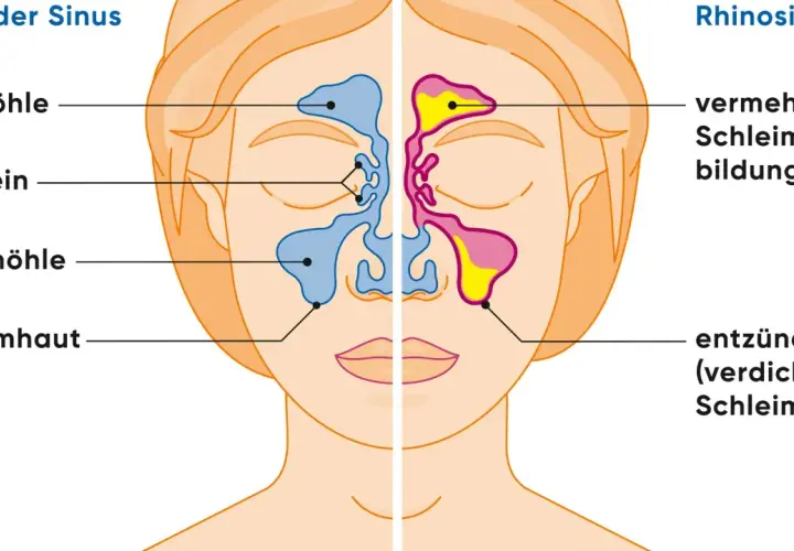 Vergleich gesunder Sinus und Rhinosinusitis: Entzündete Schleimhaut und vermehrte Schleimbildung sind typische nasennebenhöhlenentzündung symptome.