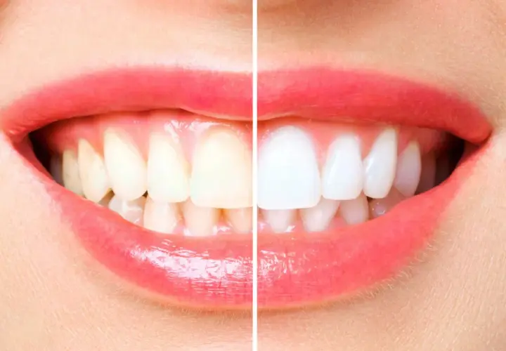 Sorriso diviso: a sinistra denti ingialliti, quasi senza smalto, a destra bianchissimi e splendenti.