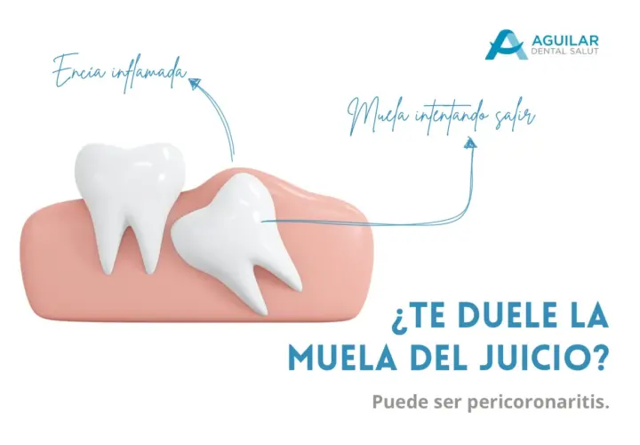Ilustración de una muela del juicio impactada y encía inflamada, causando dolor de cabeza. Pregunta: ¿Te duele la muela del juicio?
