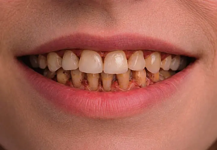 Boca con dientes amarillentos y encías inflamadas, mostrando signos de periodontitis crónica.