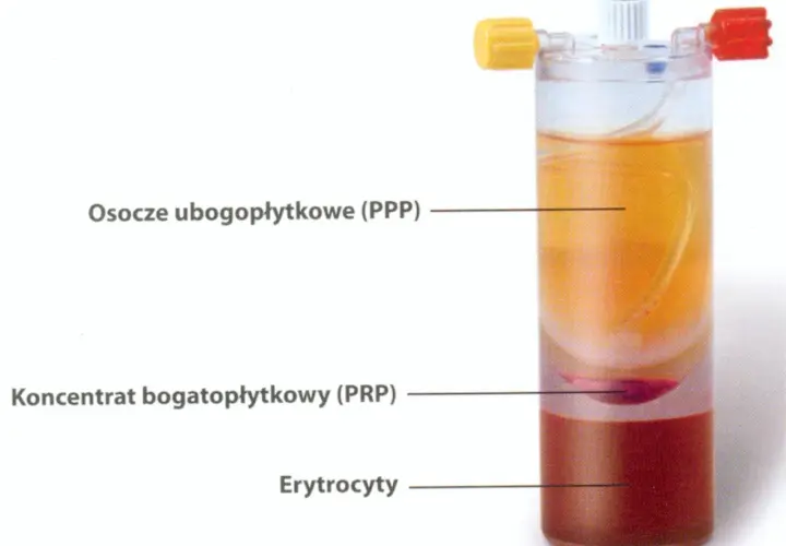 Probówka z rozwarstwionym osoczem: osocze ubogopłytkowe (PPP), koncentrat bogatopłytkowy (PRP) i erytrocyty.