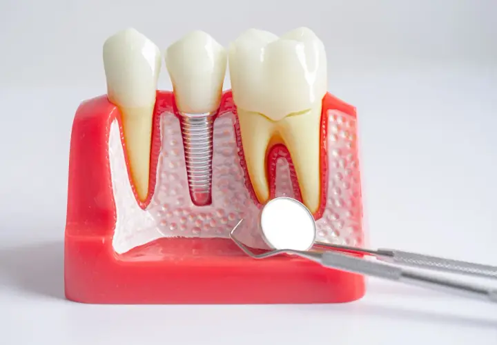Modello dentale con impianto: anche con la piorrea si possono mettere i denti fissi. Strumenti dentistici in primo piano.