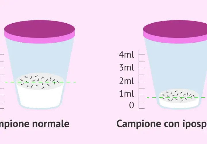 Confronto tra campione normale e ipospermia. La curiosità quando un uomo non viene, mostra una ridotta quantità di spermatozoi.