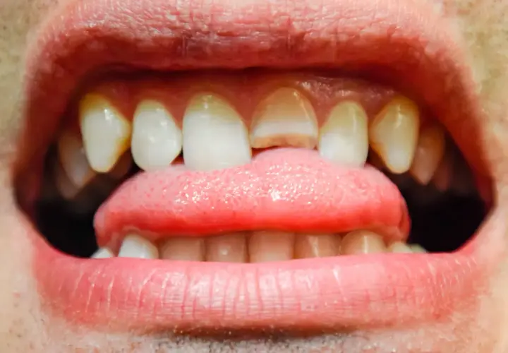 Primer plano de una boca abierta mostrando dientes delanteros con grietas visibles y una lengua rosada.