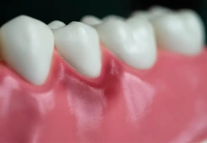 Detalle de dientes y encías, mostrando una leve inflamación en la encía de una muela.