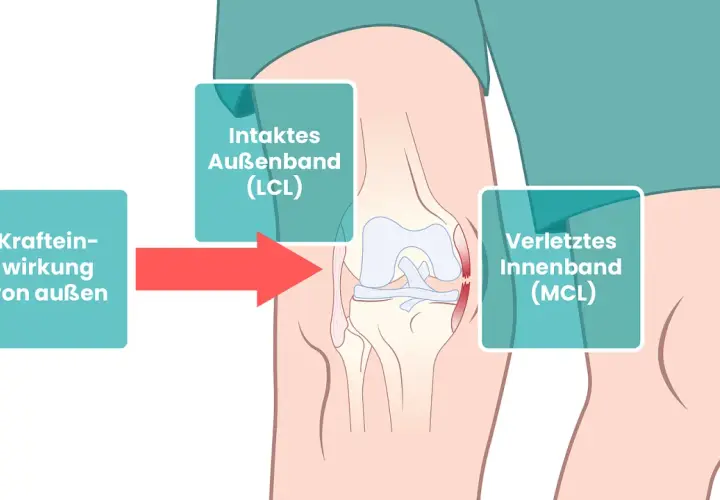 Schema zeigt Kniegelenk mit Kraftwirkung von außen, die zu einem verletzten Innenband (MCL) führt.