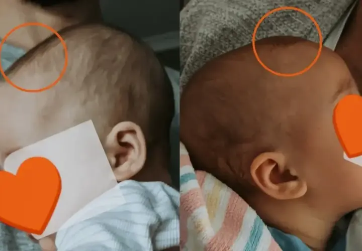 Dwa ujęcia główki niemowlaka, pokazujące jak zarasta ciemiączko. Na obu zdjęciach widoczne są pomarańczowe kółka zaznaczające obszar ciemiączka.