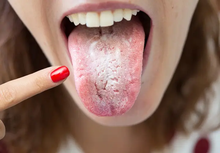 Una persona se señala la lengua, que se ve blanca y con una textura áspera y seca, indicando posible candidiasis oral.