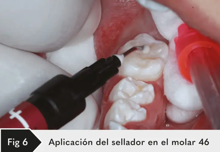 Aplicación de sellante dental en el molar 46. Un aplicador dental deposita el material en las fisuras del diente.
