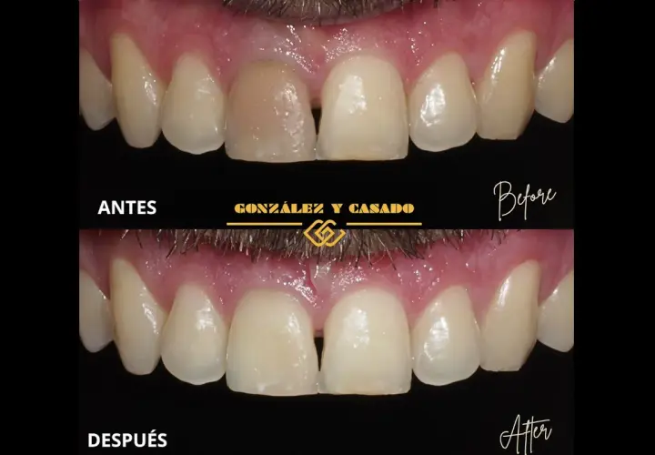 Antes y después de tratar un diente muerto. El diente oscuro se ha blanqueado y restaurado para que coincida con los demás.