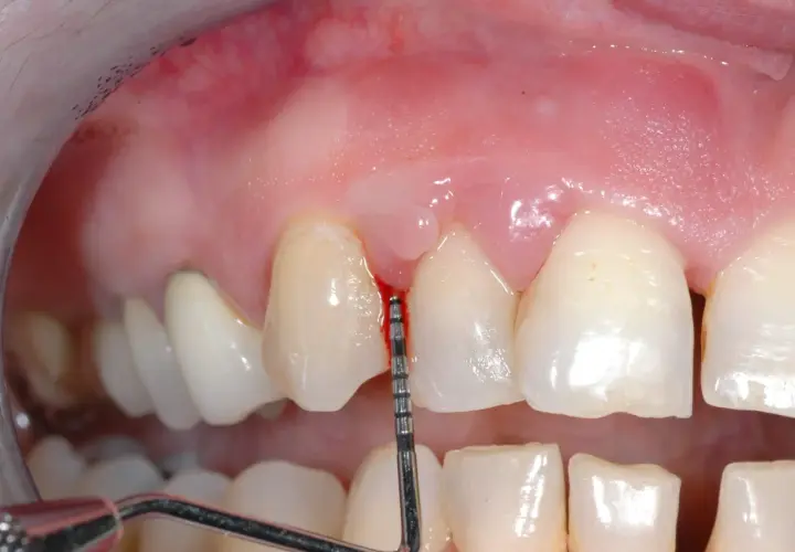 Strumento dentale misura la profondità gengivale. Alcuni credono che la pulizia dei denti rovina i denti, ma è fondamentale per la salute orale.