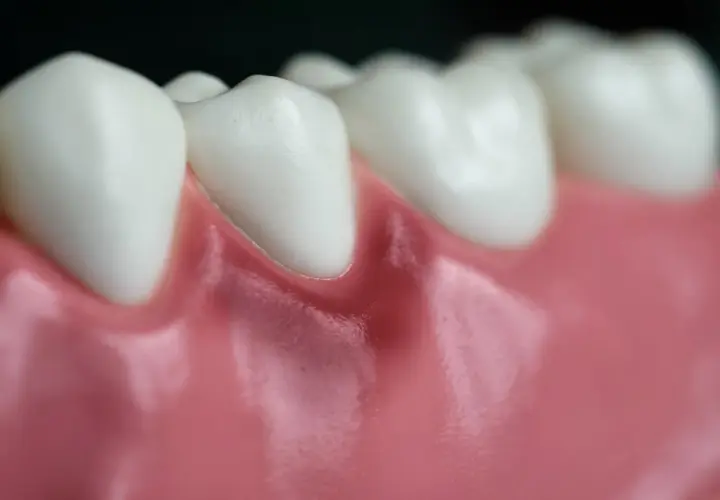 Detalle de dientes blancos y una encía roja en un diente, mostrando la línea de la encía.