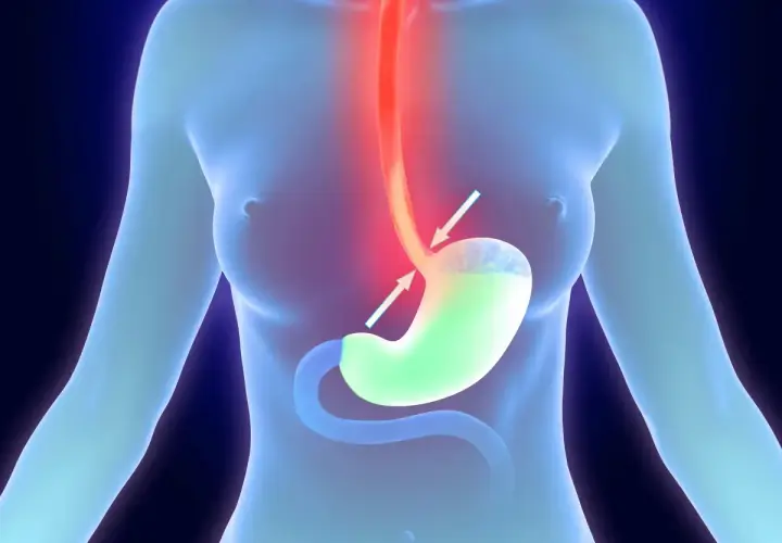 Illustrazione anatomica che mostra un esofago irritato e uno stomaco con reflusso, suggerendo ansia e strane sensazioni allo stomaco.