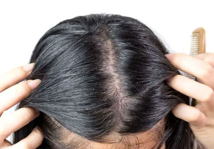 Cuoio capelluto con forfora visibile, sintomo comune della dermatite seborroica. Mani che separano i capelli scuri per mostrare le squame bianche.