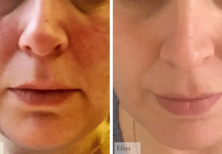 Före och efterbilder visar en minskning av rodnad och synliga blodkärl, vilket indikerar förbättrad rosacea hud.