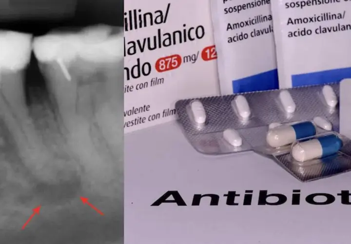 Radiografia di un ascesso dentale con confezioni di antibiotico amoxicillina/acido clavulanico.